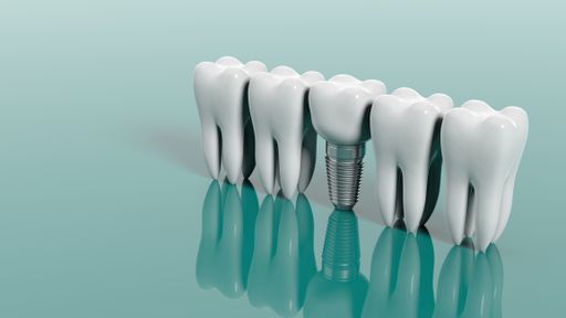 Zahnimplantat zwischen normalen Zähnen
