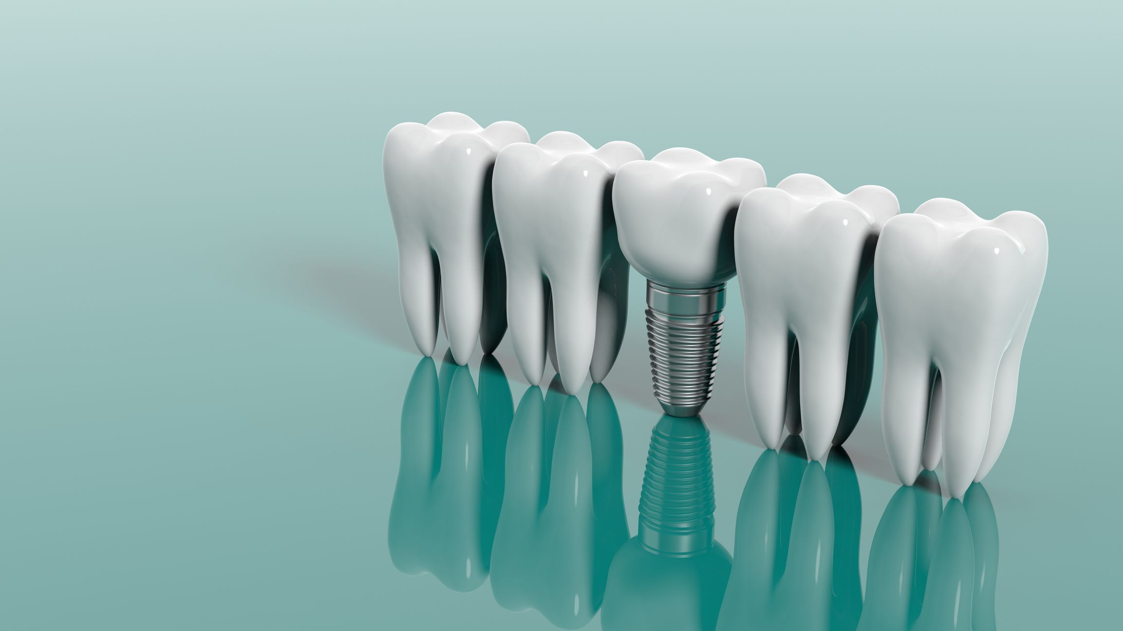 Zahnimplantat zwischen normalen Zähnen